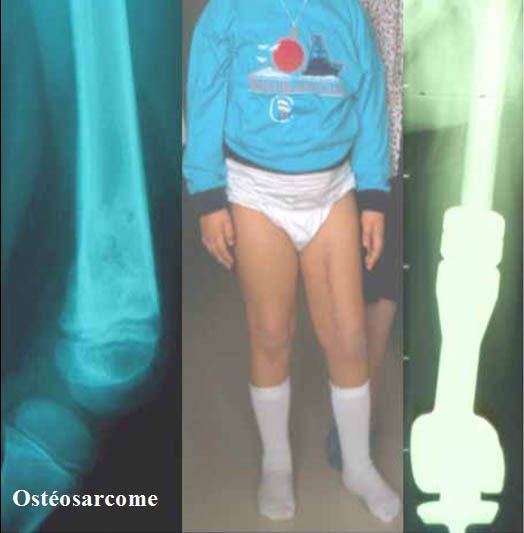 Ostéosarcome