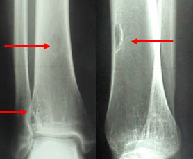 Radios lésions diaphysaire