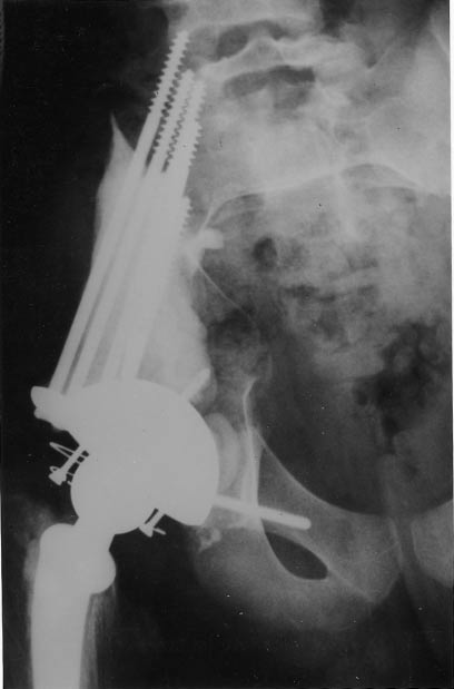 Chondrosarcoma treated by monoblock resection