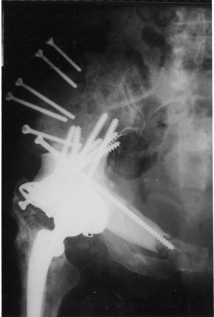 Resection of zones II and III in a patient with healthy gluteus muscles