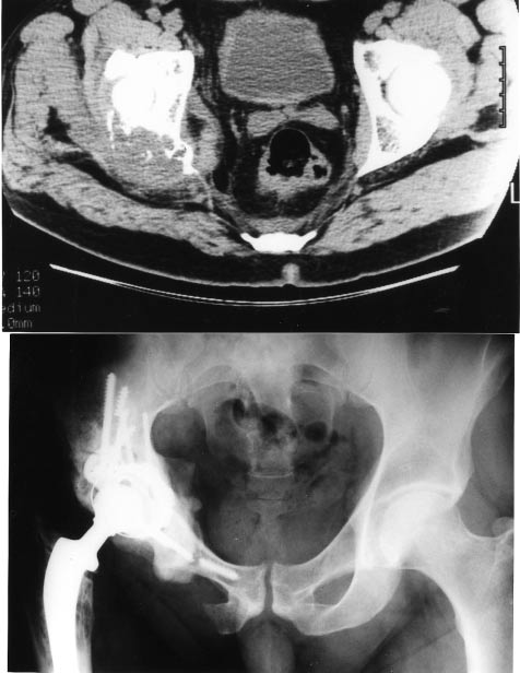 Solitary metastases revealing a kidney carcinoma