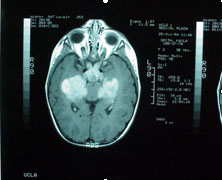 IRM of brain of child